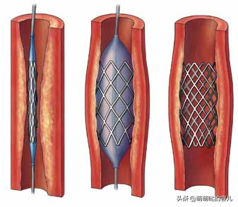 让我们正视脑血管植入手术，建议为心脑血管病人收藏