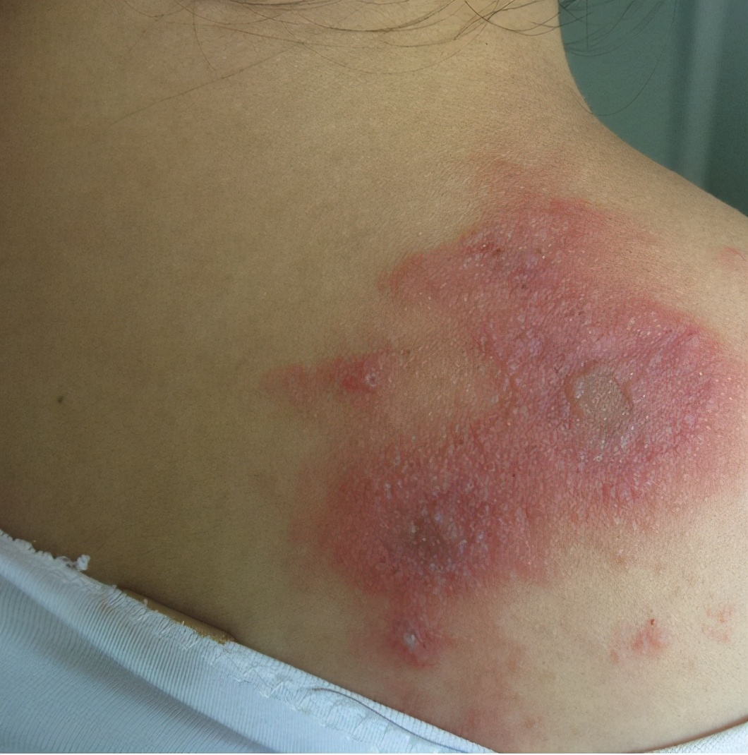 拍一下就会皮肤溃烂的虫子—隐翅虫