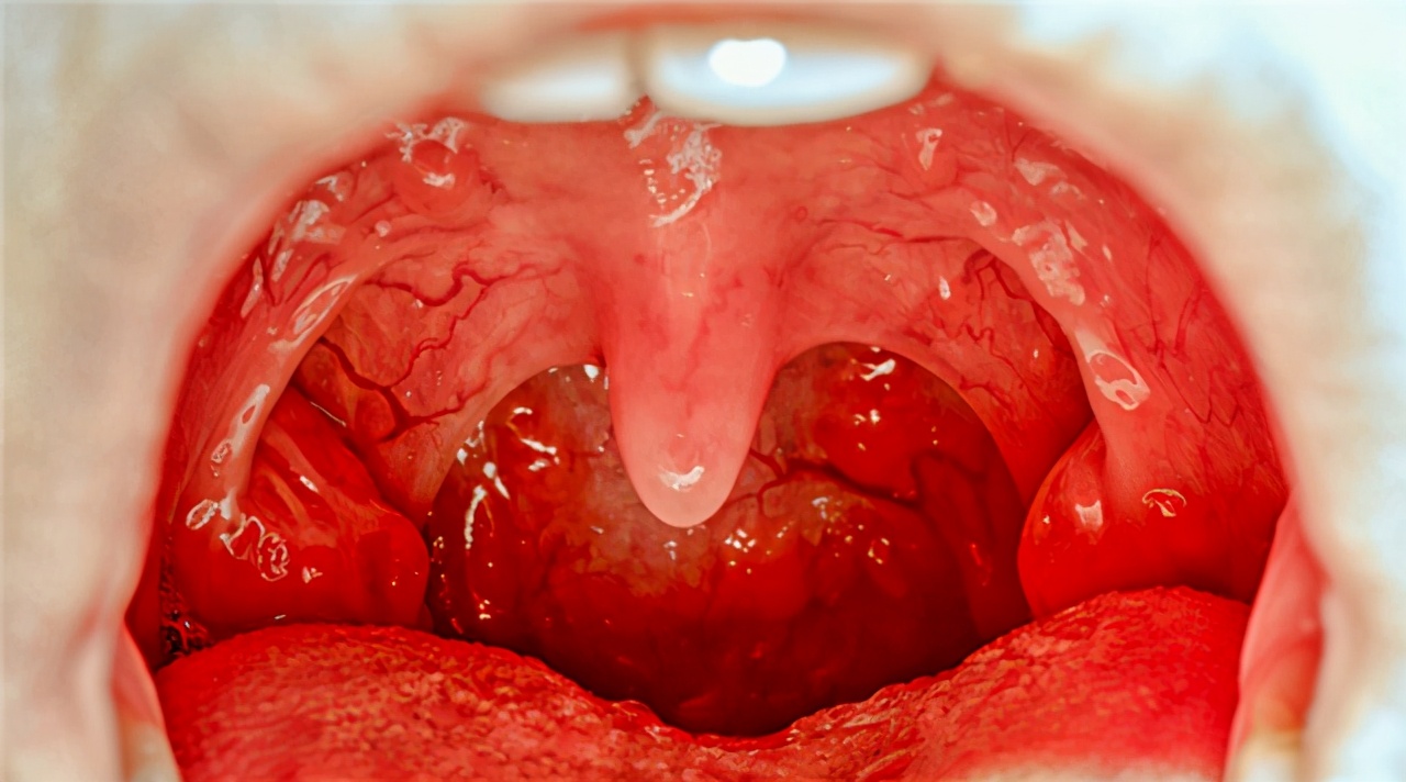咽炎与正常的咽喉图片(喉癌) - 赤虎壹号