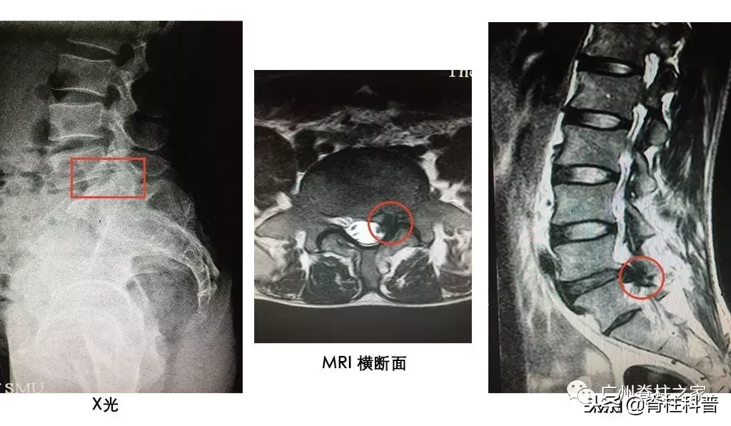 在骨科，X光、CT、MRI（核磁共振）各有优势，不是越贵越好！