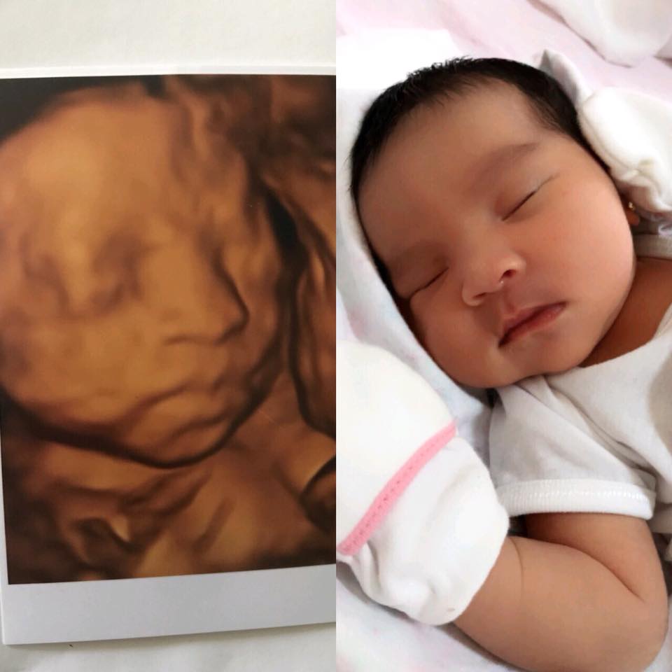 孕期做四维检查，了解这些指标，不用求医生，自己看胎儿是否健康
