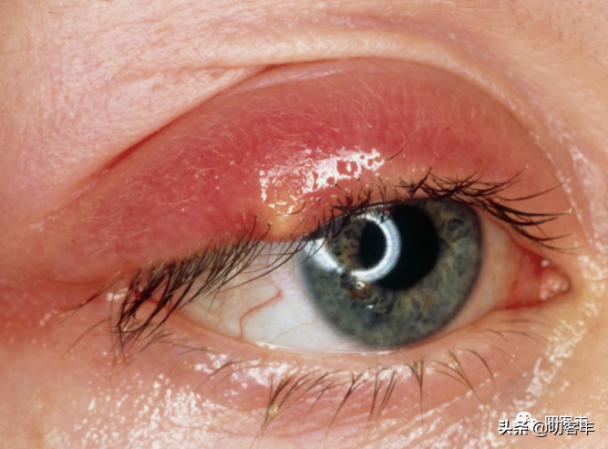 针眼(麦粒肿)怎么治疗?