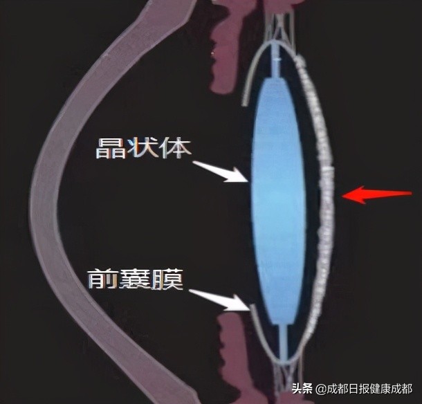 白内障什么时候手术？术后会出现哪些状况？你想了解的都在这里