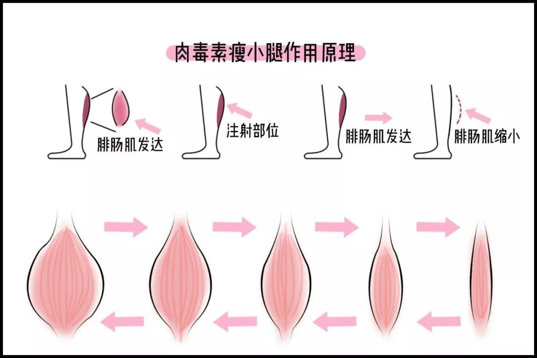 打了溶脂针多久见效除皱(脸部打溶脂针一般多久见效)