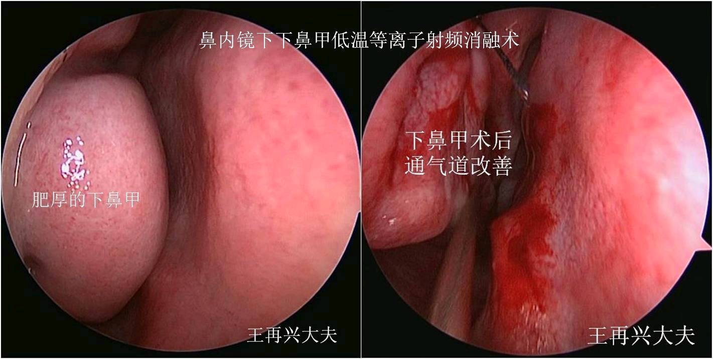 鼻塞无法改善，鼻子越来越难受？医生给出了这4点治疗建议