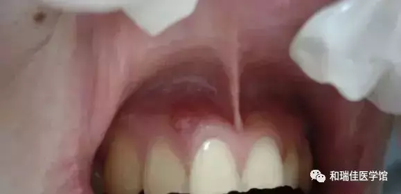 牙龈脓包快速消除方法：有效处理牙龈肿痛问题