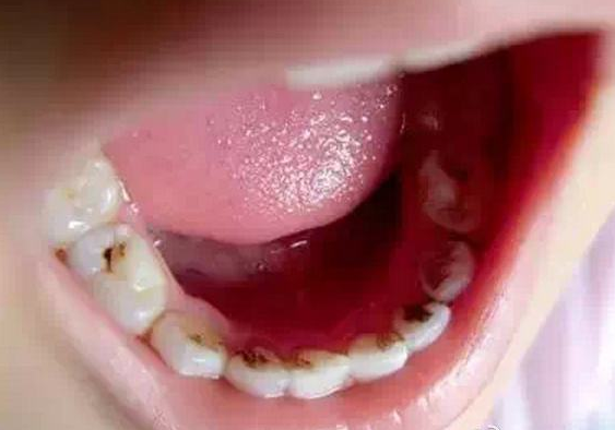 牙齿发黑发黄是怎么回事？不痛不痒需要看医生吗？其实问题很大