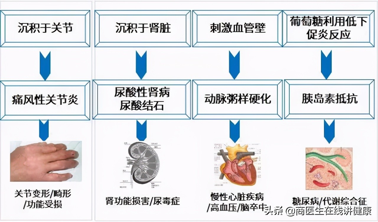 高尿酸血症是如何形成的?