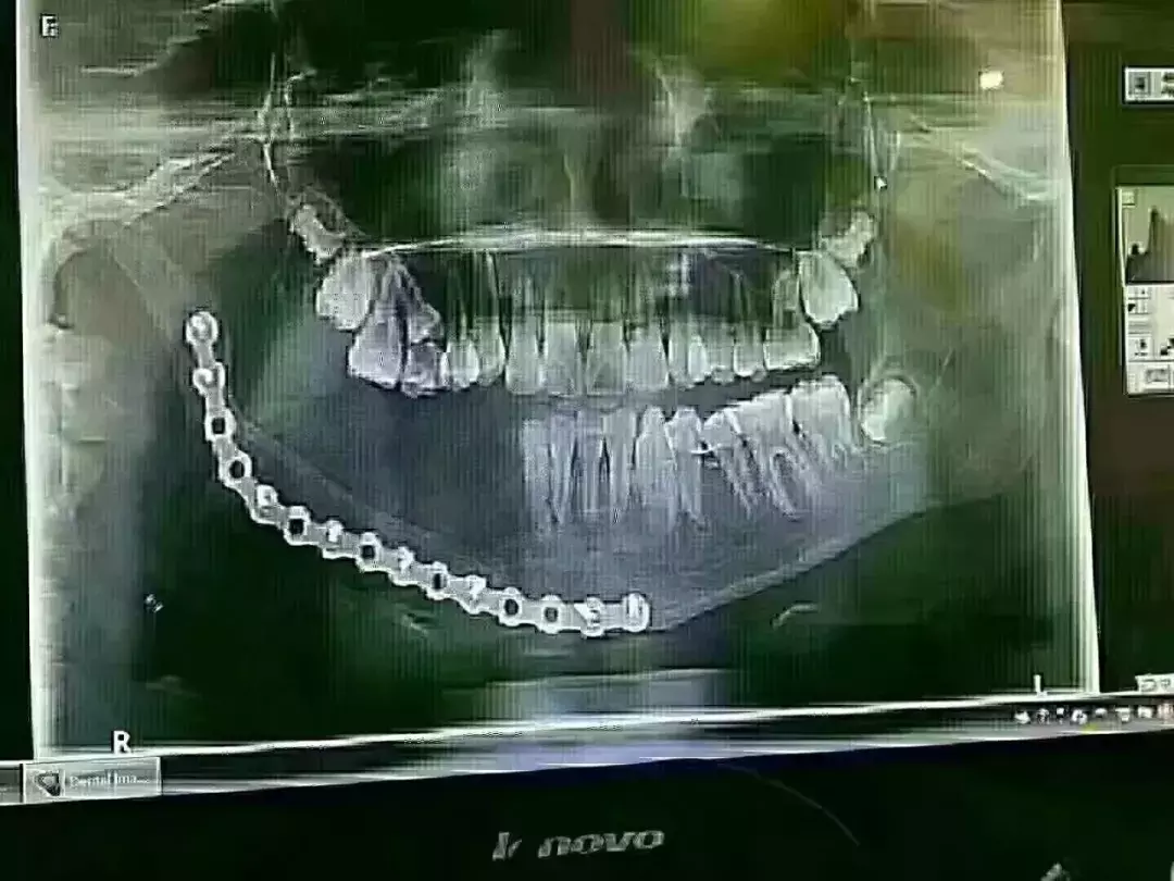 乳牙坏了怕啥？最终这个孩子花了16万，做了下颌骨切除手术！