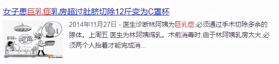 被“巨乳症”折磨的女生，有苦说不出：就像胸前挂着11瓶矿泉水