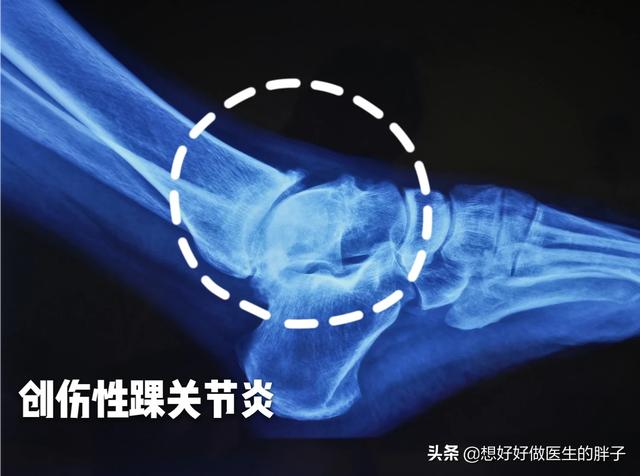 辟谣I“崴脚脖子很正常，拍片子做核磁都是浪费钱”真是这样吗？