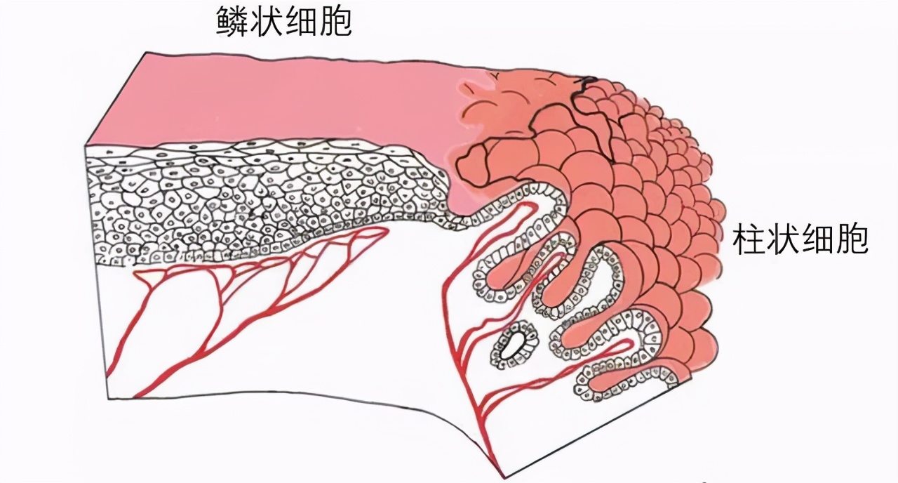 “宫颈糜烂”真的让你恐惧吗？别被忽悠了，过度治疗反伤宫颈