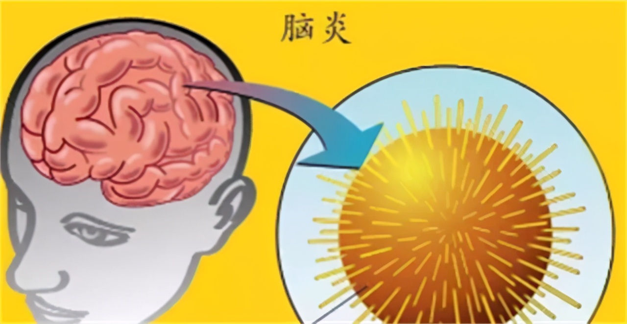 孩子头疼恶心想吐是怎么回事(小孩得了病毒性脑炎)