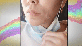 哈尔滨女子花5万做面部填充术，结果还得分三次取出！卫生监督所已展开调查