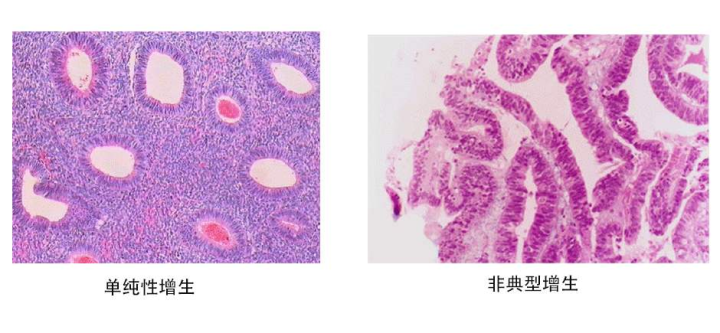 子宫内膜增厚不好怀孕，该怎么办