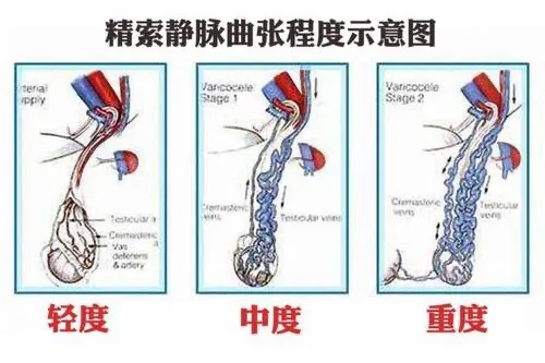 精索静脉曲张要不要做手术?顺便看看外科医生的工作日常