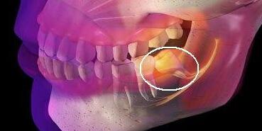 智齿拔除之后有牙洞该怎么办？又该注意哪些事项？