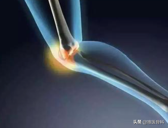 伤筋动骨，必须要一百天才能好？骨科医生：不一定