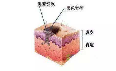 指甲出现黑线可能是什么疾病的征兆？