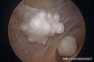 走走路突然膝盖就软了，要摔倒，还疼，是啥情况？医生详细告诉您