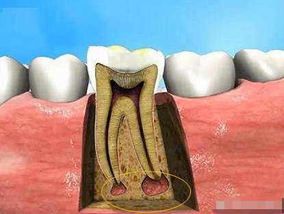 牙根尖周炎治疗多少钱根尖周炎该怎么治疗