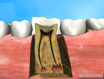 根尖周炎该怎么治疗？根尖周炎久拖不治会有什么后果？