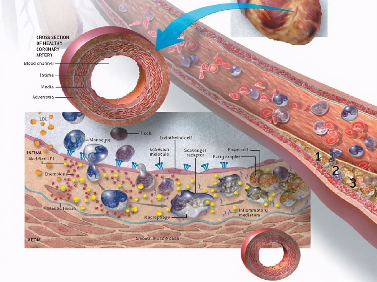 得了冠心病，整天担惊受怕的，就怕心梗猝死，该怎么办