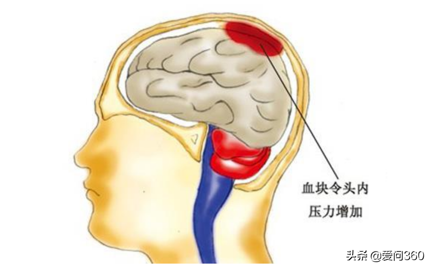 脑淤血和生活习惯有关？真没瞎说，预防才是关键