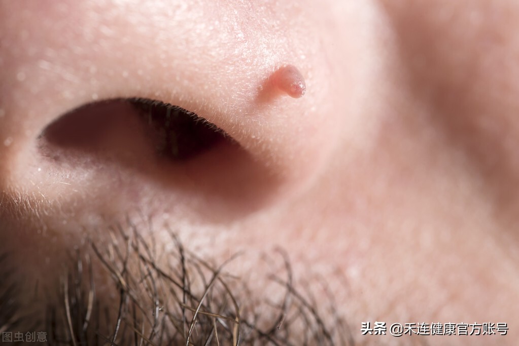 身上长着 6 种小疙瘩,一定要警惕,可能癌变,传染