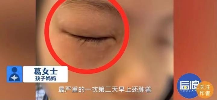 婴儿眼睛肿（9岁女孩一做数学题）