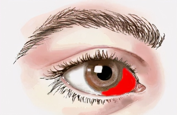 当心这三种眼病