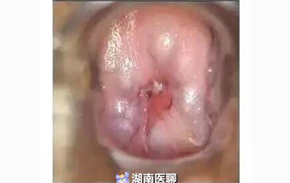 宫颈囊肿形成原因及预防措施