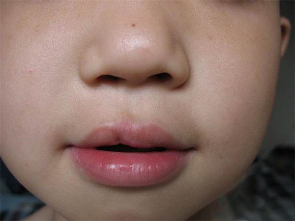 先天性唇腭裂儿童图片