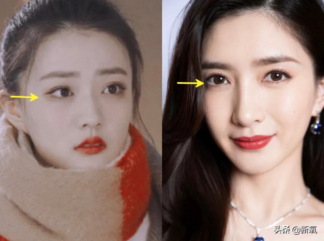 姐妹,双眼皮再好,咱也别硬割啊