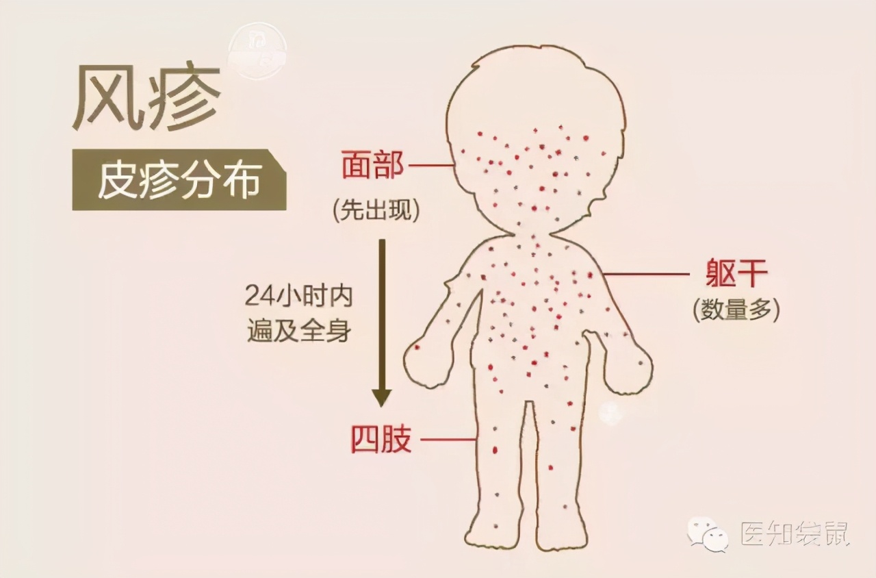 川崎病很像感冒，但会严重损伤心脏，5岁以下儿童易中招