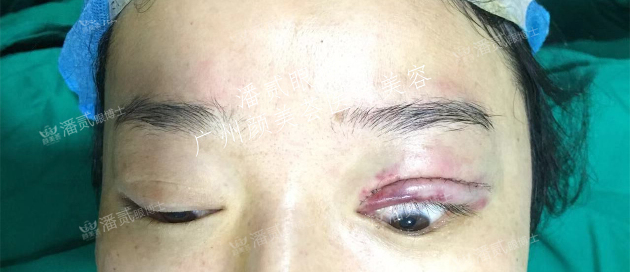 手术步骤:重睑线设计,暴露睑板,从结膜上分离61 在上直肌前1/3和提