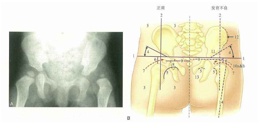 担心宝宝髋关节发育不良？几个方法来筛查，治疗黄金期更不能错过