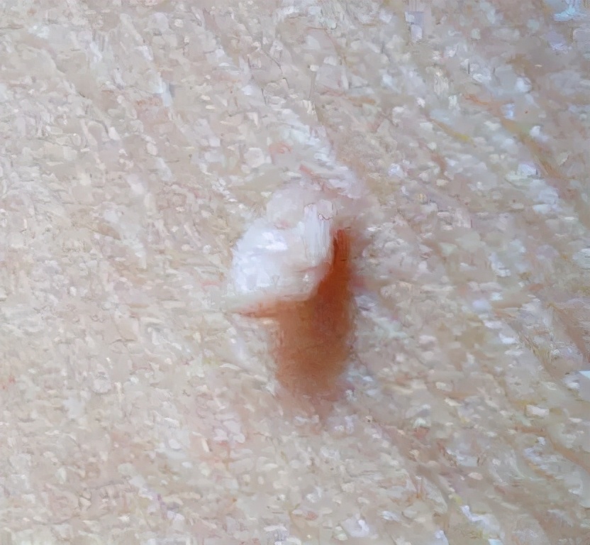 皮肤上的小肉球、小肉疙瘩是什么？不出意外，这4种可能性较大