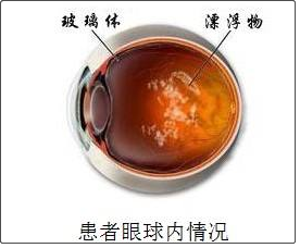 正常眼角内息肉图片(俗称的飞蚊症) - 赤虎壹号