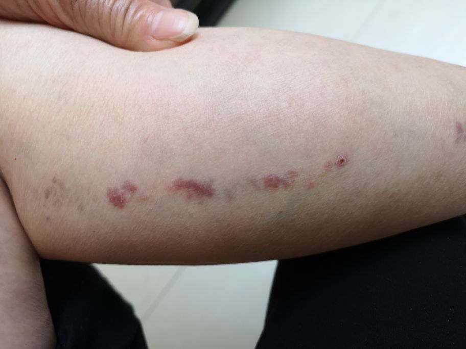 长成一条线的就是线状苔癣?