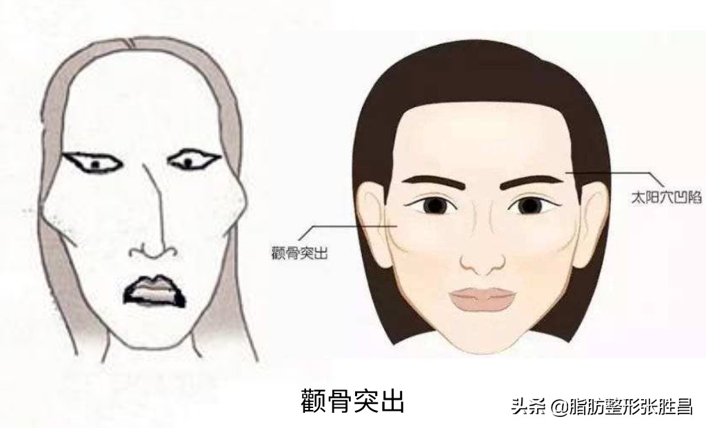 脸蛋显凶,被人说刻薄?颧骨突出:一个影响你后天颜值的先天因素