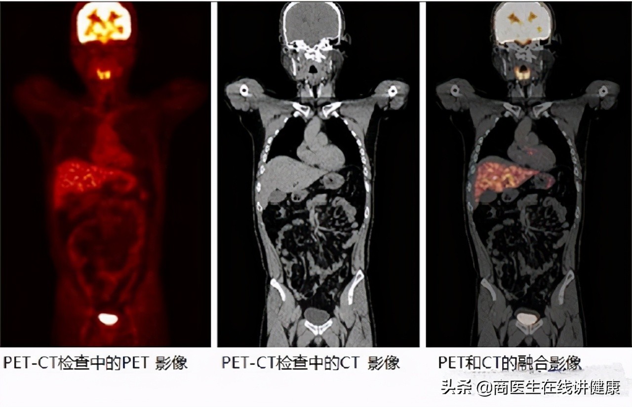 1万一次的PET-CT是什么？值得做吗？