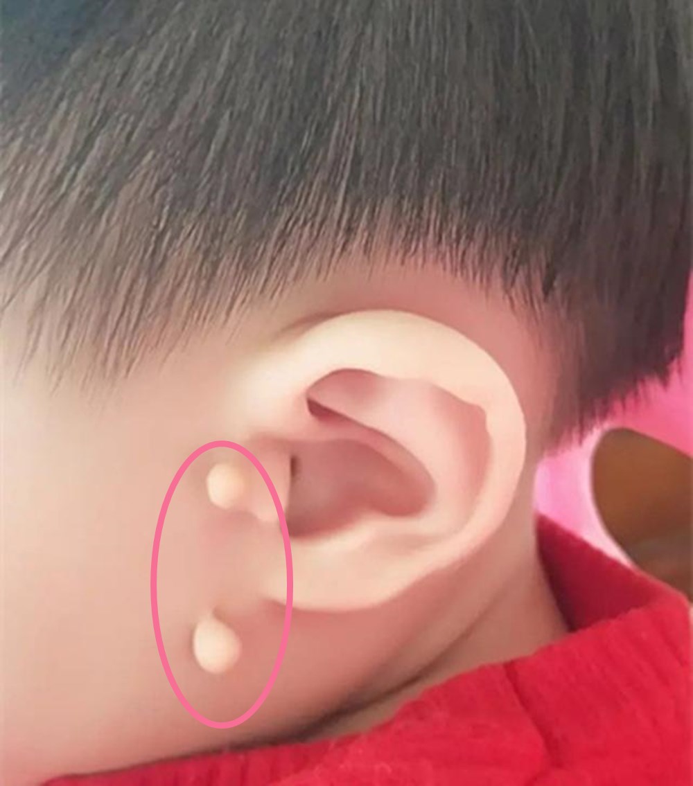 婴儿有附耳(耳边多) - 乐宝宝贝