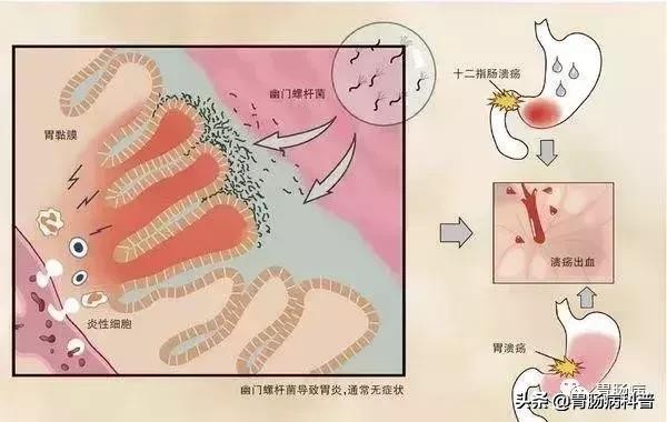 感染了幽门螺杆菌，哪些人不宜根除？