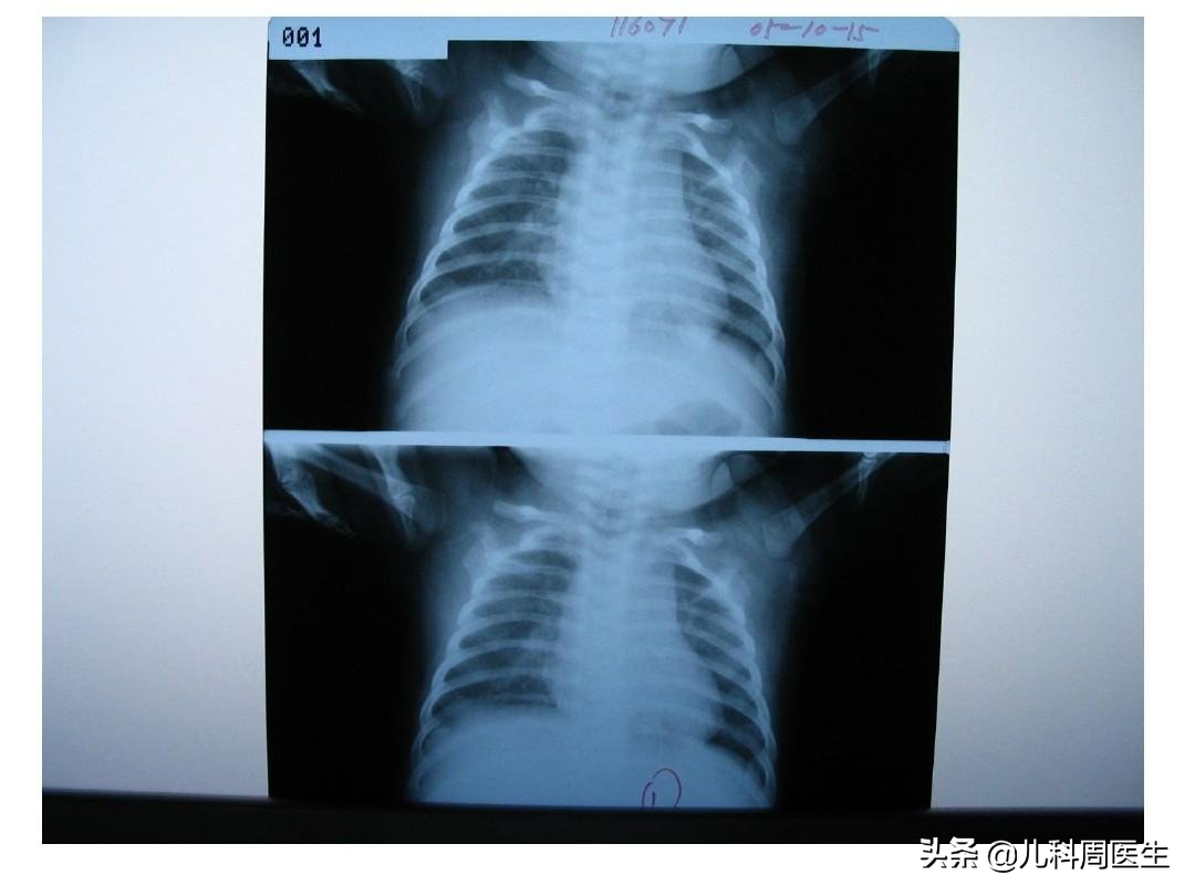 宝宝“喘憋、气促、三凹征”是什么病？当心，毛细支气管炎高风险