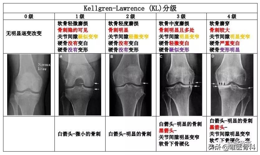 打“玻璃酸钠”对身体会有哪些影响？要注意这 5 点