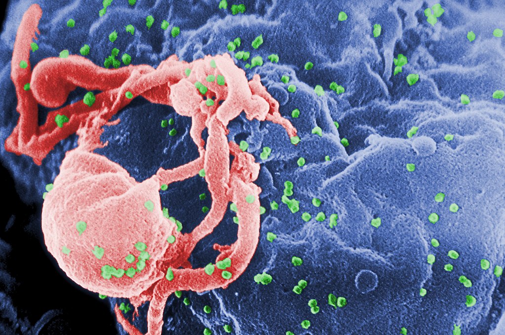 世界上第1个得艾滋病的人，是被谁传染得？艾滋病起源之谜