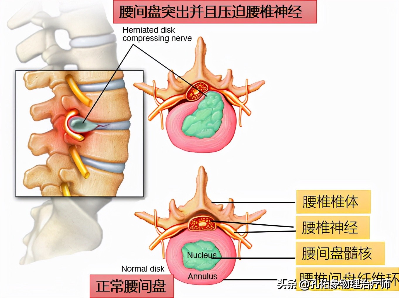 腰臀部疼或下肢麻木，是腰椎间盘突出吗？9种疾病需鉴别