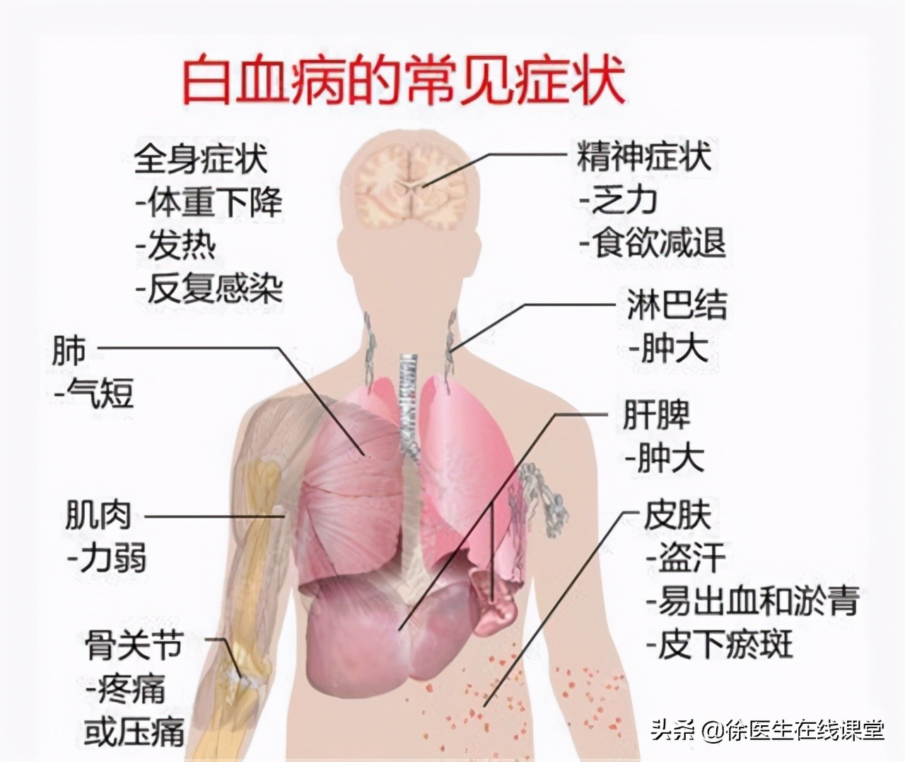 越来越多孩子得白血病，家长注意：孩子有5大异常，需及时排查