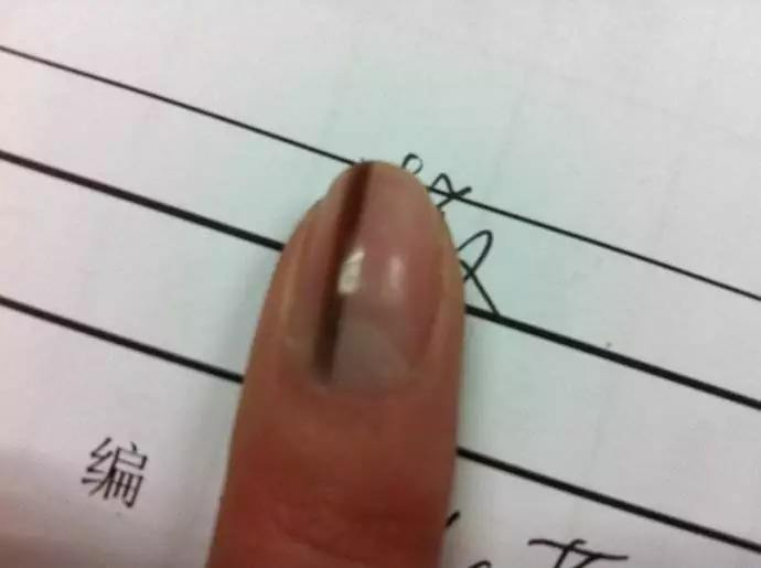 指甲上有条黑线是什么病？甲黑色素瘤or甲母痣？良性还是恶性？